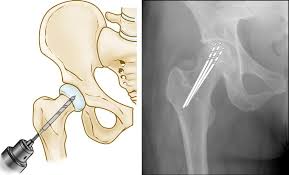 Quick Recovery Hip Surgery In Harda