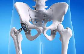 Quick Recovery Hip Surgery In Sagar
