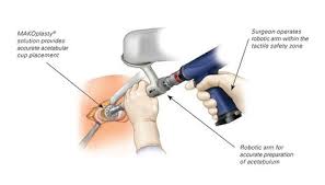 Robotic Hip Replacement Ayushman Bharat In Sagar