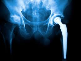 Robotic Hip Replacement In Gadchiroli