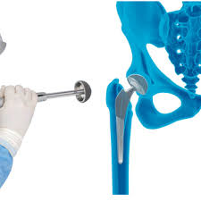 Robotic Hip Surgery In Gondia