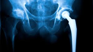 Robotic-assisted Hip Replacement In Betul