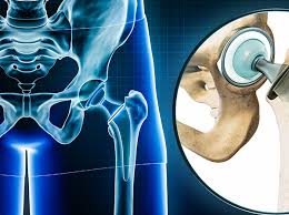 Robotic-assisted Hip Replacement In Gondia