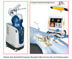 Cashless Robotic Hip Replacement In Shahdol