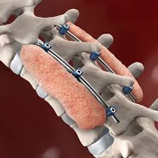 Spine Surgery in Amaravti