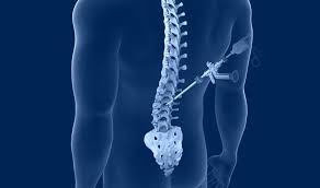 Spine Surgery in Itarsi
