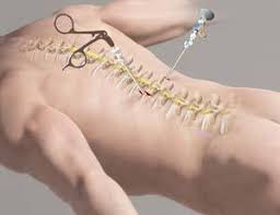 Spine Surgery in Hoshangabad
