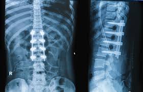 Spine Surgery in Shahdol