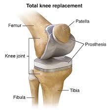 Total Knee Replacement in Betul