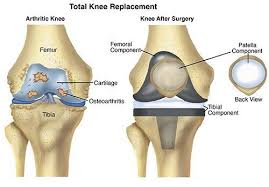Total Knee Replacement in Betul