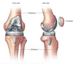 Total Knee Replacement in Bhandara