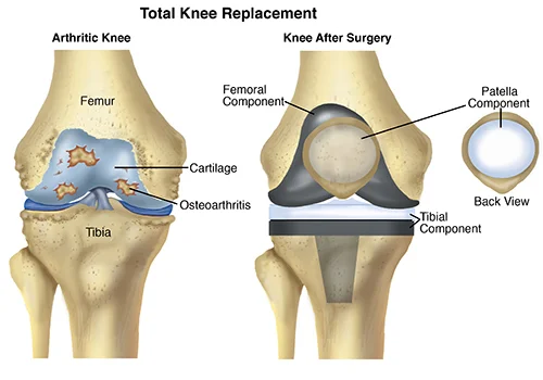 Total Knee Replacement in Gondia