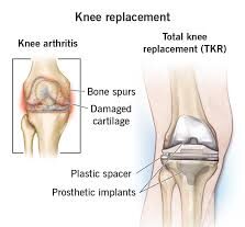 Total Knee Replacement in Katni