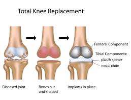 Total Knee Replacement in Yavatmal