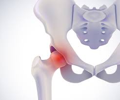 AVN treatment Adilabad