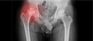 AVN treatment Adilabad