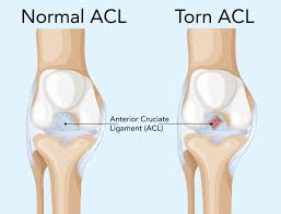 Acl ligament treatment Bhopal