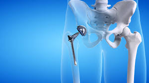 Advanced Hip Replacement In Balaghat