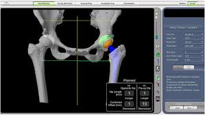 Robotic Hip Replacement Ayushman Bharat In Adilabad