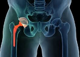 CGHS Hip Replacement In Adilabad
