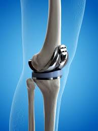 Joint Replacement Low Cost In Bhopal