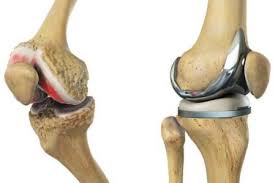 Joint Replacement Low Cost In Gadchiroli