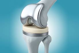 Knee replacement Bhopal
