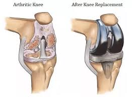 Knee replacement Bhopal
