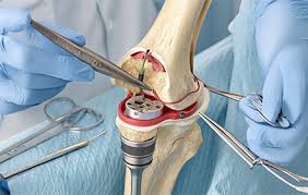 Knee replacement Itarsi