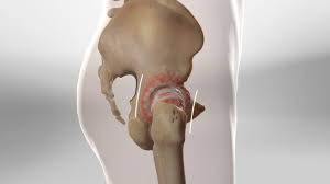 Minimally Invasive Hip Surgery In Balaghat