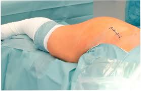 Minimally Invasive Hip Surgery In Balaghat