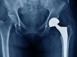 Precision Hip Replacement In Adilabad