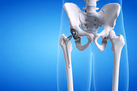 Precision Hip Replacement In Adilabad