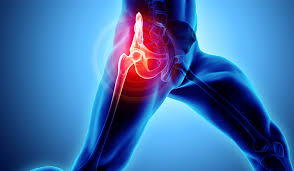 Precision Hip Replacement In Balaghat
