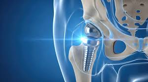 Precision Hip Replacement In Balaghat