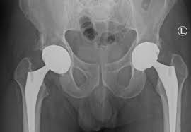 Precision Hip Replacement In Bhopal