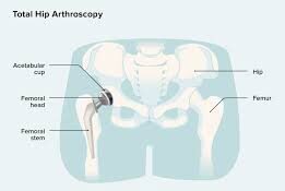 Quick Recovery Hip Surgery In Bhopal