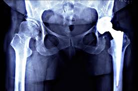 Quick Recovery Hip Surgery In Bhopal