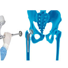 Robotic Hip Surgery In Balaghat