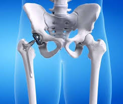 Robotic Hip Surgery In Bhopal