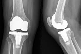 Total Knee Replacement in Chhindwara