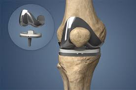 Total Knee replacement Rewa