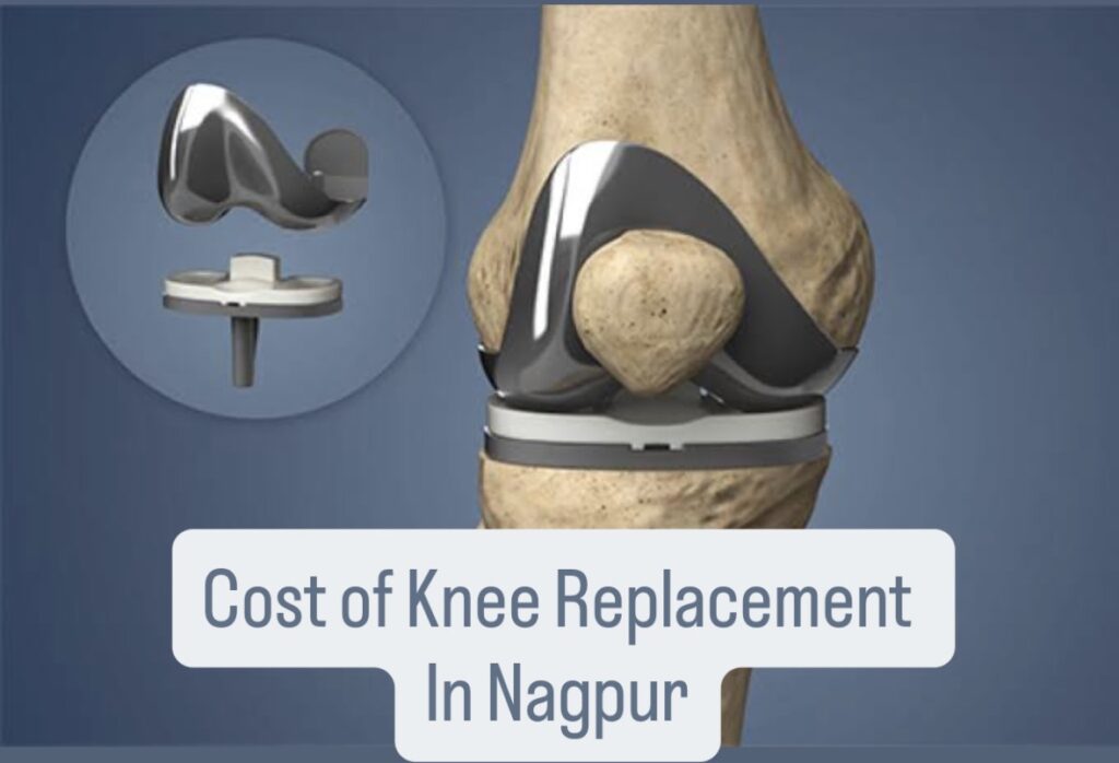 Cost of Knee Replacement