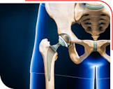 Cost of Hip Replacement in Nagpur