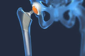 Advanced hip replacement Nagpur