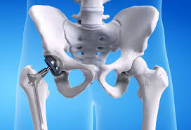 Advanced hip replacement Nagpur