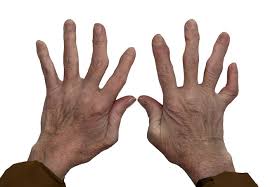Arthritis Doctor In Nagpur