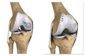 Best Joint Replacement In Nagpur