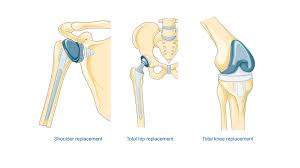 Best Joint Replacement In Nagpur