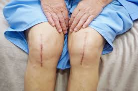 Best Knee Replacement In Nagpur